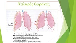 Χαλαρός θώρακας
• Αναπνευστική υποστήριξη με συσκευή Ambu
• Ακινητοποίηση του παράδοξα κινούμενου τμήματος
• σε εσωτερική θέση π.χ. πίεση με το χέρι
• Ενδοφλέβια χορήγηση υγρών για διατήρηση
• περιφερικής γραμμής
• Γρήγορη μεταφορά για οριστική αντιμετώπιση
 