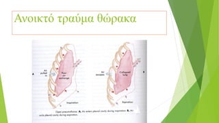 Ανοικτό τραύμα θώρακα
 