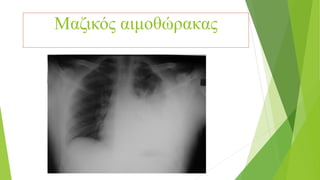 Μαζικός αιμοθώρακας
 