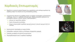 Καρδιακός Επιπωματισμός
 Οφείλεται σε κλειστό τραύμα θώρακα που προκαλείται από απότομη συμπίεση της
καρδιάς μεταξύ του στέρνου και της σπονδυλικής στήλης.
 Η συμπιεστική κάκωση της καρδιάς μπορεί να επιφέρει καταστάσεις με δυνατότητα
επιβίωσης, όπως π.χ. καρδιακό επιπωματισμό, θλάση μυοκαρδίου (μώλωπα του
μυοκαρδίου μερικού ή ολικού πάχους, αιμοπερικάρδιο )
 Διάταση των σφαγίτιδων φλεβών
 Σημεία ολιγαιμικής καταπληξίας.
 Μπορεί ναπαρατηρηθεί παράδοξος σφυγμός (μείωση ή απουσία σφυγμού κατά την
εισπνοή).
 Αναπνευστική υποστήριξη με συσκευή Ambu
 Ενδοφλέβια χορήγηση υγρών με διατήρηση περιφερικής γραμμής
 Γρήγορη μεταφορά για οριστική αντιμετώπιση.
 Περικαρδιοπαρακέντηση ή καρδιακό παράθυρο
 