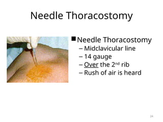 Needle Thoracostomy
Needle Thoracostomy
– Midclavicular line
– 14 gauge
– Over the 2nd
rib
– Rush of air is heard
24
 