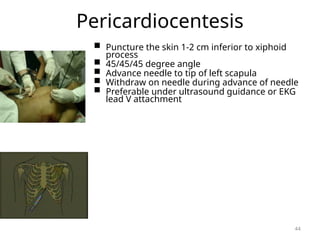 Pericardiocentesis
 Puncture the skin 1-2 cm inferior to xiphoid
process
 45/45/45 degree angle
 Advance needle to tip of left scapula
 Withdraw on needle during advance of needle
 Preferable under ultrasound guidance or EKG
lead V attachment
44
 