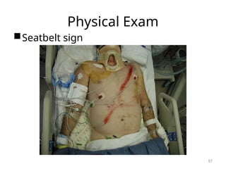 Physical Exam
Seatbelt sign
57
 