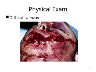Physical Exam
Difficult airway
75
 