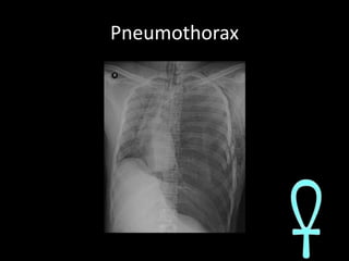 Pneumothorax<br />