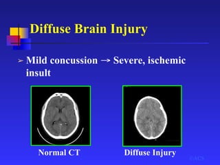 Diffuse Brain Injury
➢ Mild concussion → Severe, ischemic
insult
©ACS
Normal CT Diffuse Injury
 