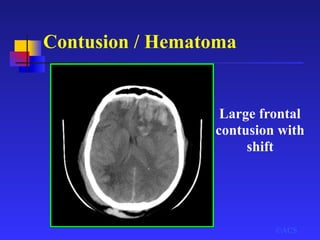 Contusion / Hematoma
©ACS
Large frontal
contusion with
shift
 
