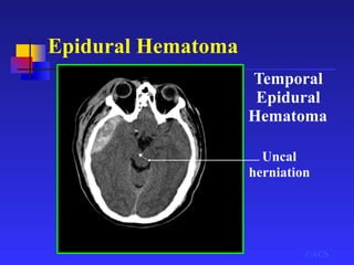 Epidural Hematoma
Uncal
herniation
Temporal
Epidural
Hematoma
©ACS
 