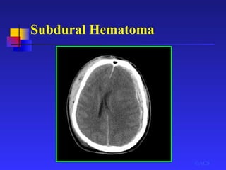 Subdural Hematoma
©ACS
 