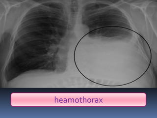 heamothorax
 