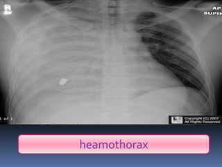 heamothorax
 