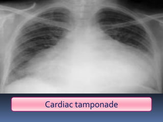 Cardiac tamponade
 