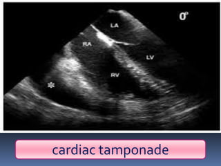 cardiac tamponade
 