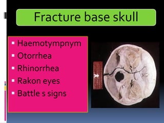 Fracture base skull
▪ Haemotympnym
▪ Otorrhea
▪ Rhinorrhea
▪ Rakon eyes
▪ Battle s signs
 