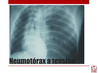 Neumotórax a tensión
 