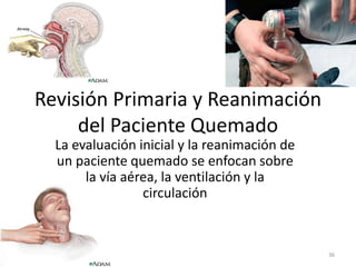 Revisión Primaria y Reanimación
del Paciente Quemado
La evaluación inicial y la reanimación de
un paciente quemado se enfocan sobre
la vía aérea, la ventilación y la
circulación
36
 