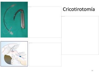 Cricotirotomía
39
 