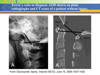 Power’s ratio to diagnose AOD shown on plain radiographs and CT scans of a patient without injury From:  Dziurzynski: Spine, Volume 30(12). June 15, 2005.1427-1432 