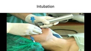 Intubation
 