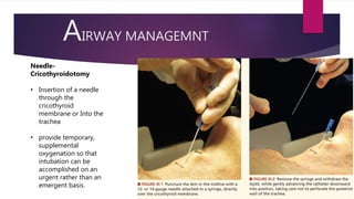 AIRWAY MANAGEMNT
Needle-
Cricothyroidotomy
• Insertion of a needle
through the
cricothyroid
membrane or Into the
trachea
• provide temporary,
supplemental
oxygenation so that
intubation can be
accomplished on an
urgent rather than an
emergent basis.
 