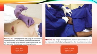 ATLS 9na
EDICION
ATLS 10ma
EDICION
 