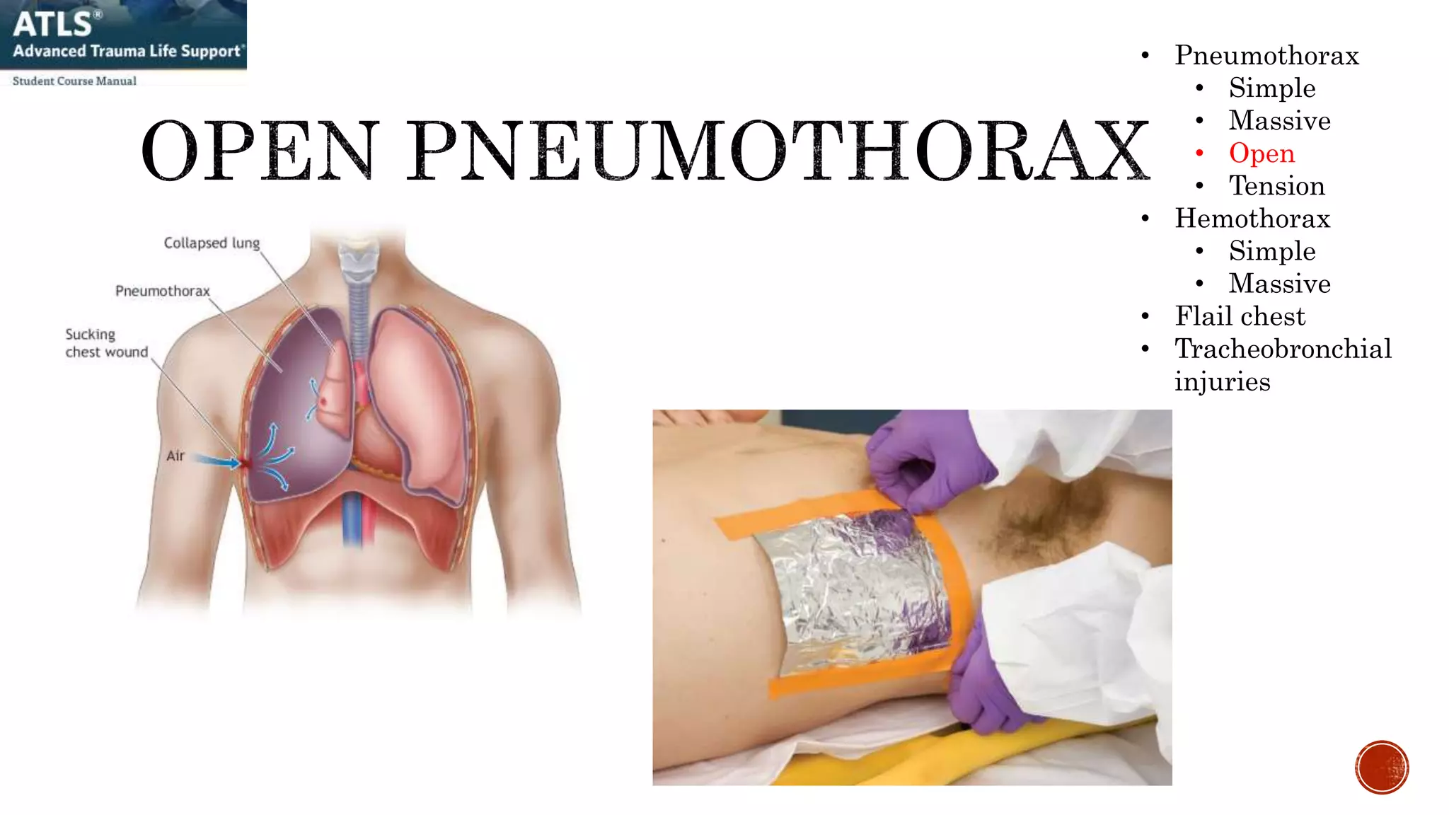 • Pneumothorax
• Simple
• Massive
• Open
• Tension
• Hemothorax
• Simple
• Massive
• Flail chest
• Tracheobronchial
injuries
 