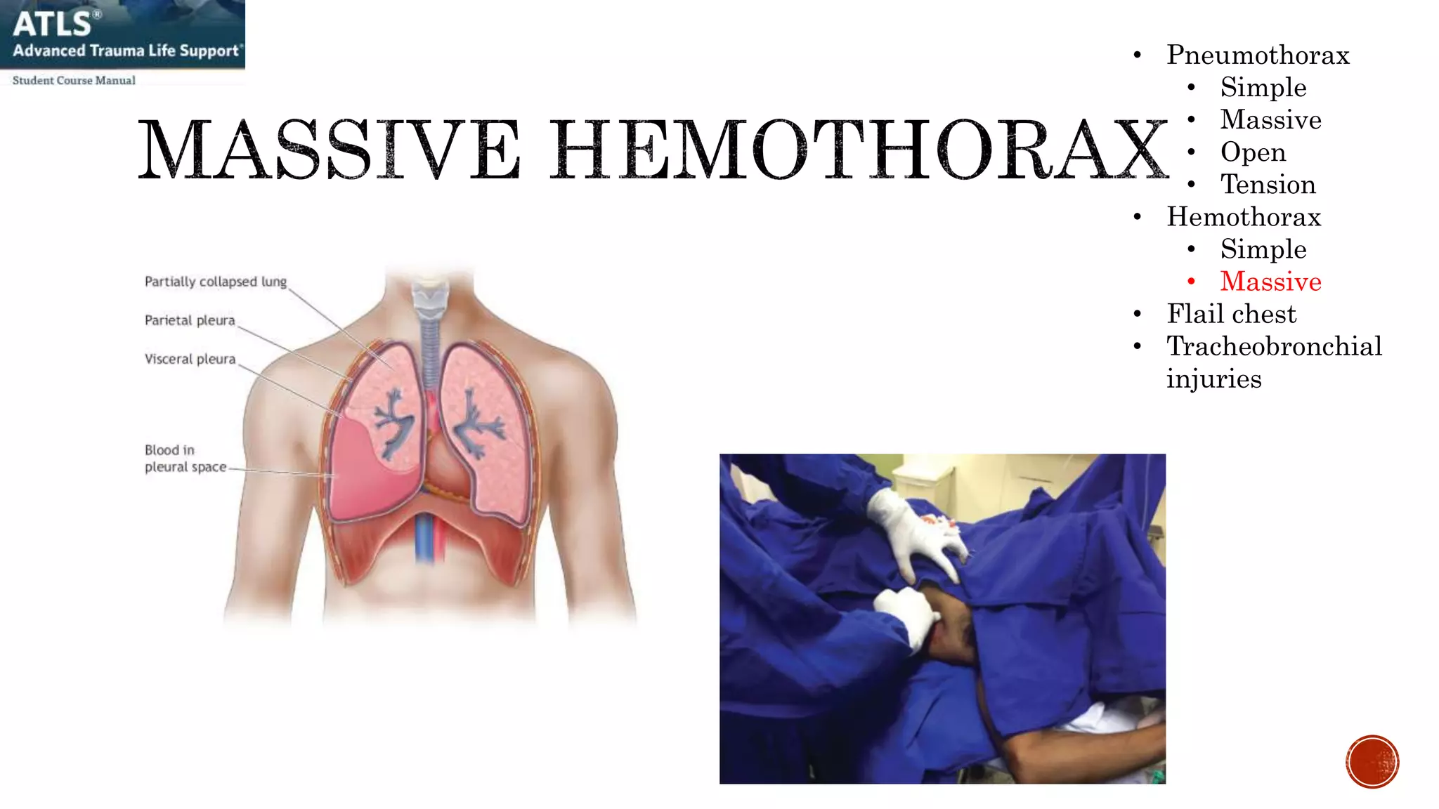 • Pneumothorax
• Simple
• Massive
• Open
• Tension
• Hemothorax
• Simple
• Massive
• Flail chest
• Tracheobronchial
injuries
 