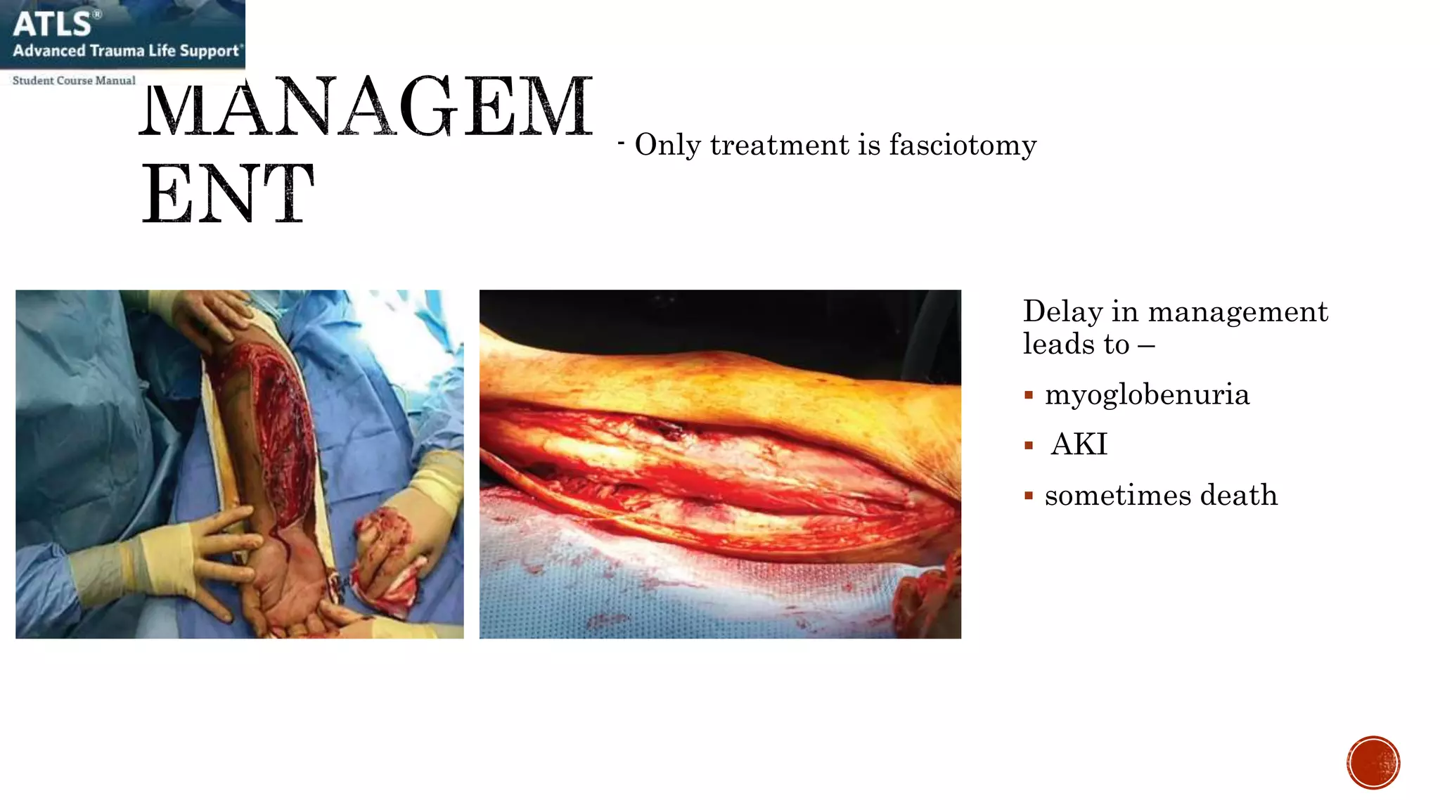 - Only treatment is fasciotomy
Delay in management
leads to –
 myoglobenuria
 AKI
 sometimes death
 