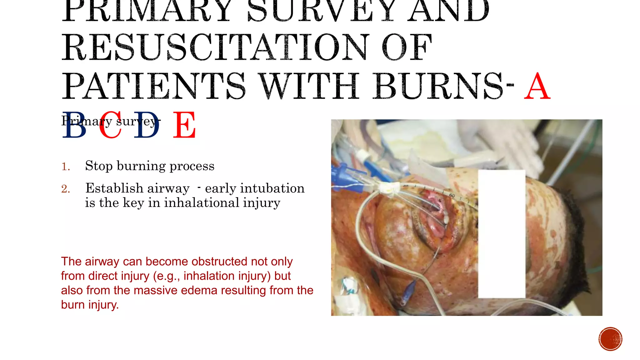 A
B C D EPrimary survey-
1. Stop burning process
2. Establish airway - early intubation
is the key in inhalational injury
The airway can become obstructed not only
from direct injury (e.g., inhalation injury) but
also from the massive edema resulting from the
burn injury.
 