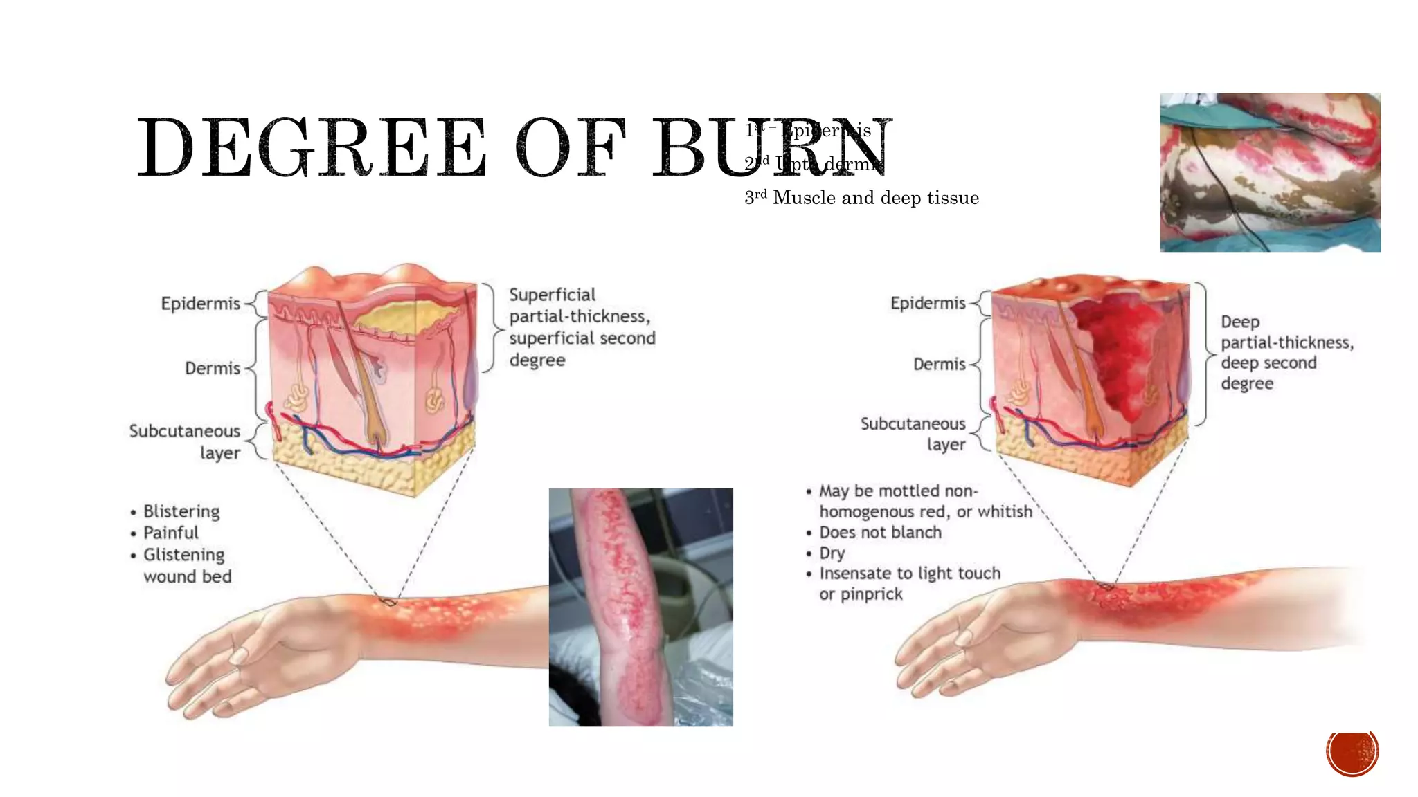 1st – Epidermis
2nd Upto dermis
3rd Muscle and deep tissue
 