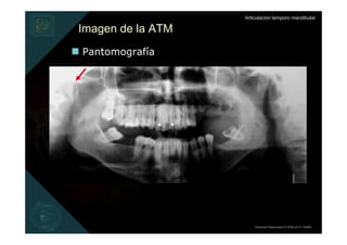 Articulación temporo mandibular

Imagen de la ATM
Pantomografía




                       Derechos Reservados © 2008 por A. Padilla
 