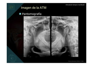 Articulación temporo mandibular

Imagen de la ATM
Pantomografía




                       Derechos Reservados © 2008 por A. Padilla
 
