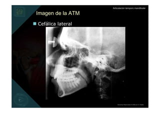Articulación temporo mandibular

Imagen de la ATM
Cefálica lateral




                       Derechos Reservados © 2008 por A. Padilla
 
