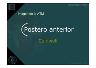 Articulación temporo mandibular




Imagen de la ATM




   Postero anterior
            Caldwell



                           Derechos Reservados © 2008 por A. Padilla
 