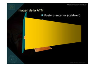 Articulación temporo mandibular



Imagen de la ATM
                   Postero anterior (caldwell)




                                        Derechos Reservados © 2008 por A. Padilla
 