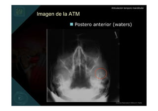 Articulación temporo mandibular


Imagen de la ATM
              Postero anterior (waters)




                                  Derechos Reservados © 2008 por A. Padilla
 