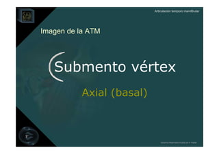 Articulación temporo mandibular




Imagen de la ATM




   Submento vértex
           Axial (basal)



                               Derechos Reservados © 2008 por A. Padilla
 