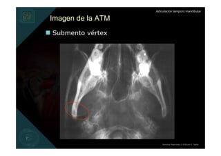 Articulación temporo mandibular

Imagen de la ATM
Submento vértex




                       Derechos Reservados © 2008 por A. Padilla
 