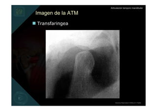 Articulación temporo mandibular

Imagen de la ATM
Transfaringea




                       Derechos Reservados © 2008 por A. Padilla
 