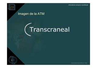 Articulación temporo mandibular




Imagen de la ATM




       Transcraneal




                       Derechos Reservados © 2008 por A. Padilla
 