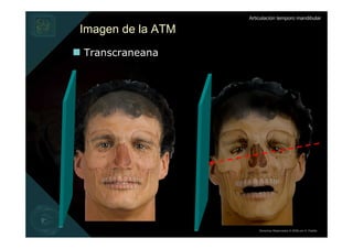 Articulación temporo mandibular

Imagen de la ATM
Transcraneana




                       Derechos Reservados © 2008 por A. Padilla
 