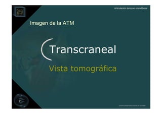 Articulación temporo mandibular




Imagen de la ATM




       Transcraneal
      Vista tomográfica



                          Derechos Reservados © 2008 por A. Padilla
 
