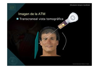 Articulación temporo mandibular




Imagen de la ATM
Transcraneal vista tomográfica




                                     Derechos Reservados © 2008 por A. Padilla
 