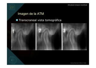 Articulación temporo mandibular




Imagen de la ATM
Transcraneal vista tomográfica




                                     Derechos Reservados © 2008 por A. Padilla
 
