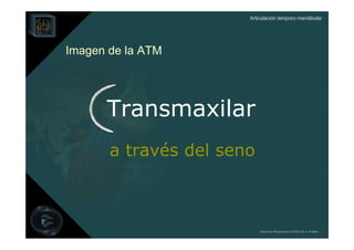 Articulación temporo mandibular




Imagen de la ATM




      Transmaxilar
       a través del seno



                           Derechos Reservados © 2008 por A. Padilla
 