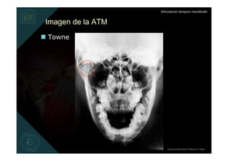 Articulación temporo mandibular


Imagen de la ATM
Towne




                       Derechos Reservados © 2008 por A. Padilla
 