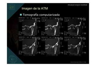 Articulación temporo mandibular


Imagen de la ATM
Tomografía computarizada




                               Derechos Reservados © 2008 por A. Padilla
 