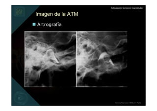 Articulación temporo mandibular


Imagen de la ATM
Artrografía




                       Derechos Reservados © 2008 por A. Padilla
 