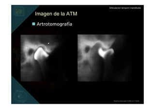Articulación temporo mandibular


Imagen de la ATM
Artrotomografía




                       Derechos Reservados © 2008 por A. Padilla
 