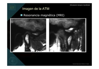 Articulación temporo mandibular


Imagen de la ATM
Resonancia magnética (MRI)




                                 Derechos Reservados © 2008 por A. Padilla
 
